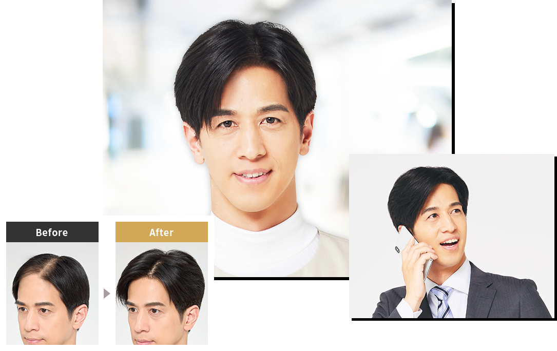 使用PINPOINT 增髮 by Aderans