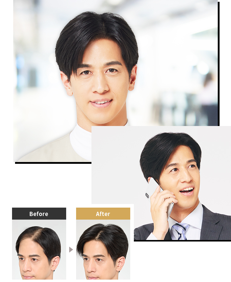 使用PINPOINT 增髮 by Aderans