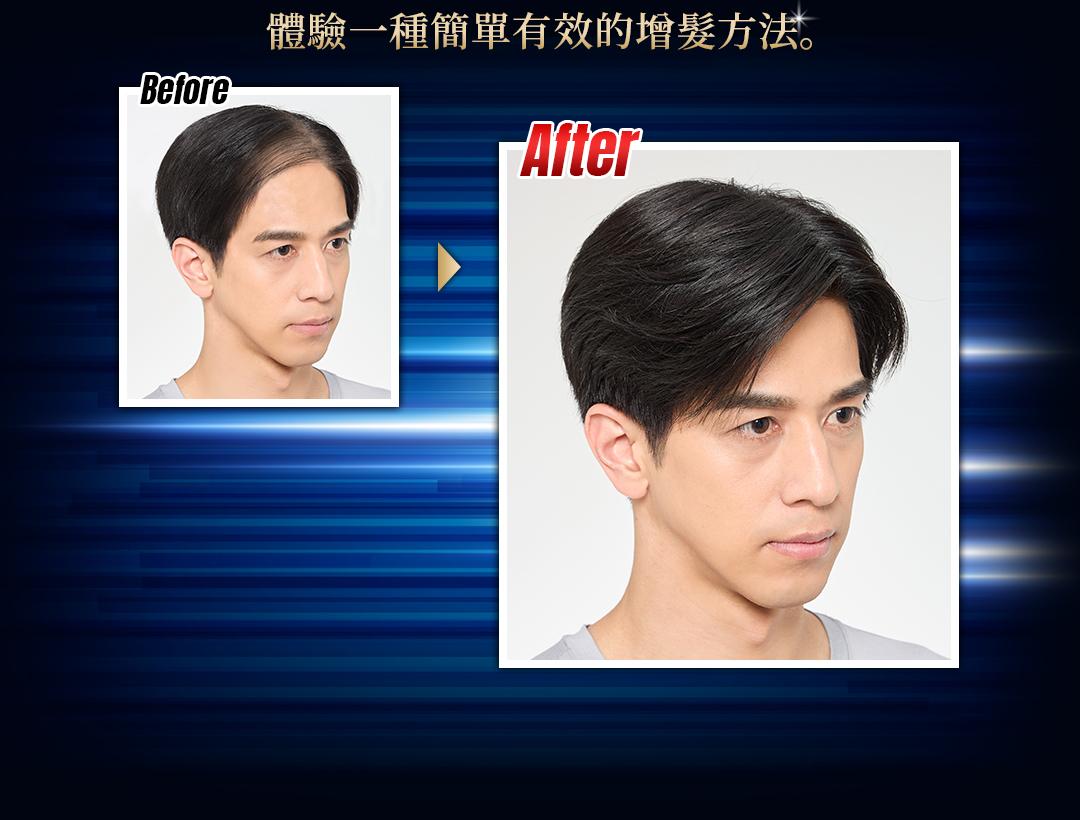 技術是利用您現有的頭髮來增加髮量