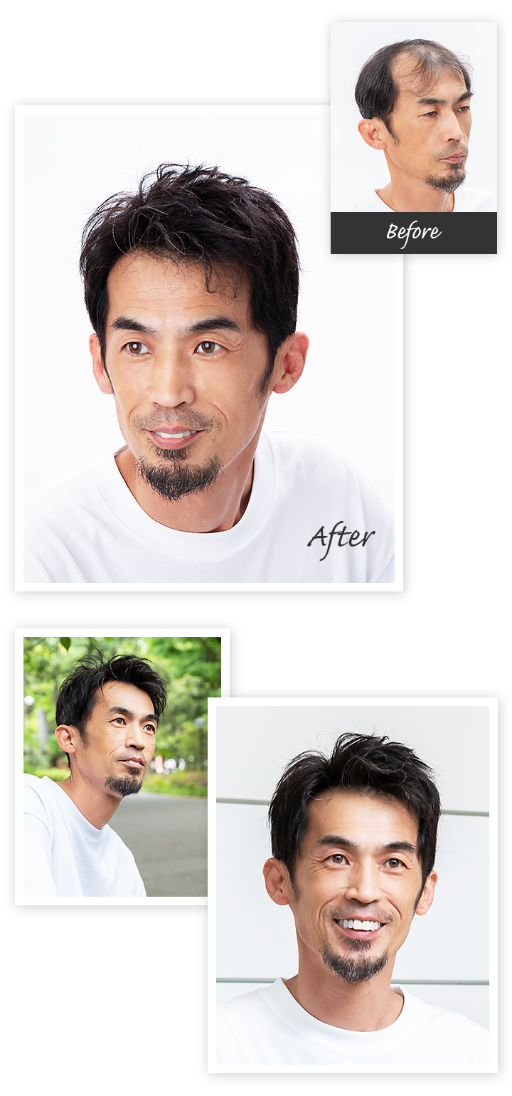 Aderans 假髮 個案1