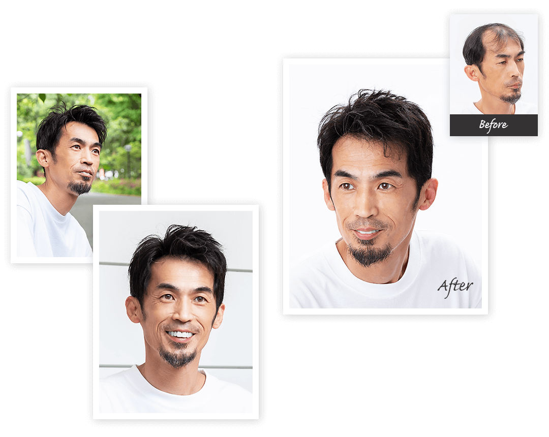 Aderans 假髮 個案1